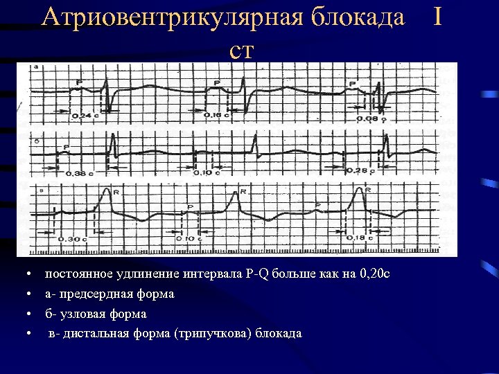 Атриовентрикулярная блокада ст • постоянное удлинение интервала P-Q больше как на 0, 20 с