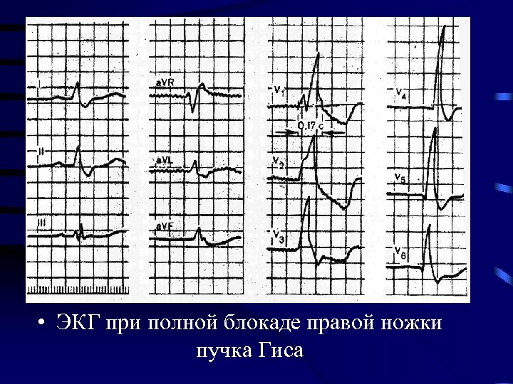  • ЭКГ при полной блокаде правой ножки пучка Гиса 