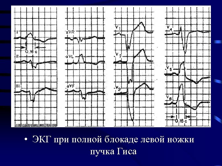  • ЭКГ при полной блокаде левой ножки пучка Гиса 