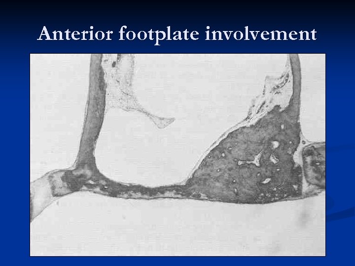 Anterior footplate involvement 