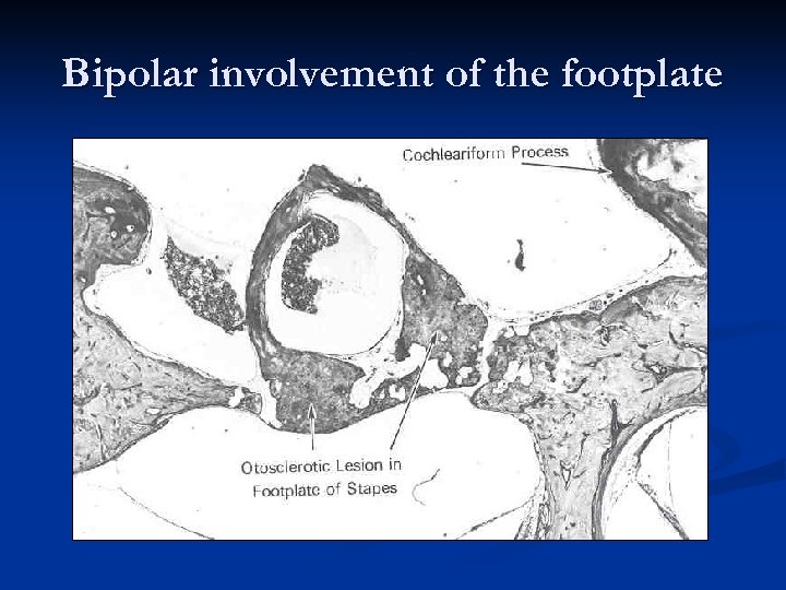 Bipolar involvement of the footplate 