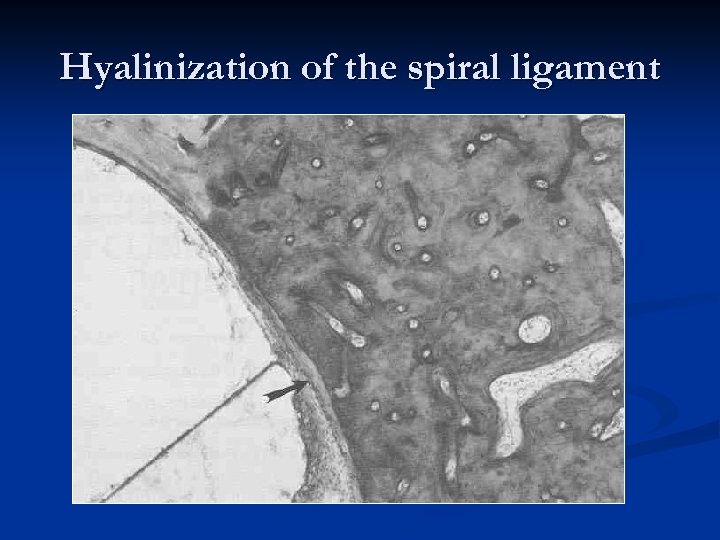 Hyalinization of the spiral ligament 