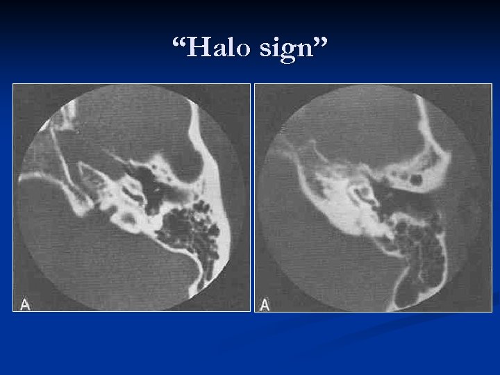 “Halo sign” 