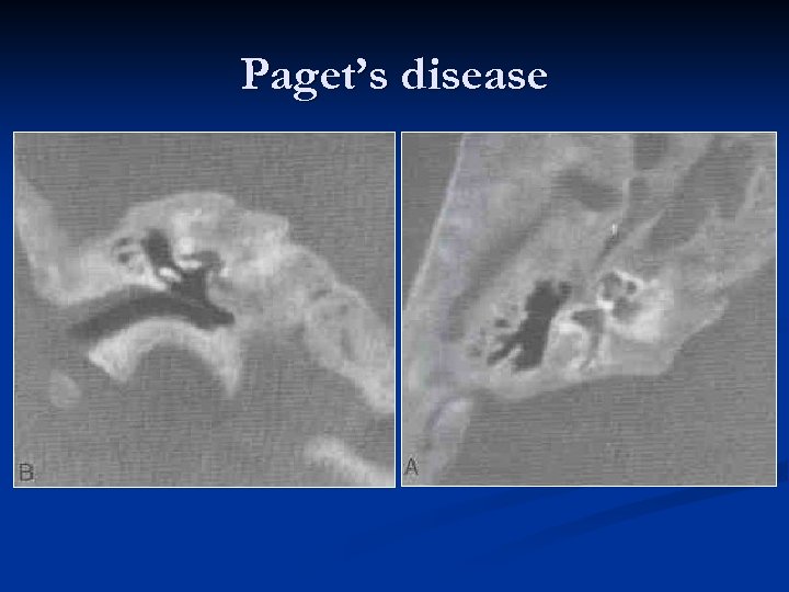 Paget’s disease 