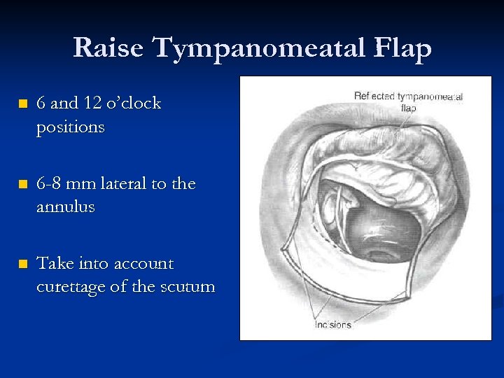 Raise Tympanomeatal Flap n 6 and 12 o’clock positions n 6 -8 mm lateral