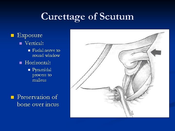 Curettage of Scutum n Exposure n Vertical: n n Horizontal: n n Facial nerve