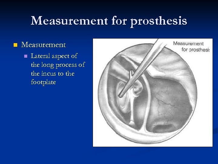 Measurement for prosthesis n Measurement n Lateral aspect of the long process of the