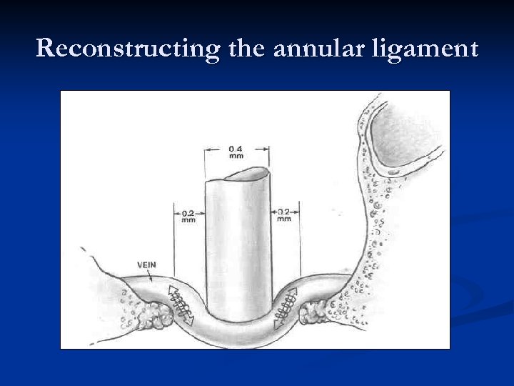 Reconstructing the annular ligament 