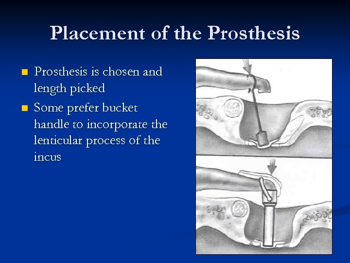 Placement of the Prosthesis n n Prosthesis is chosen and length picked Some prefer