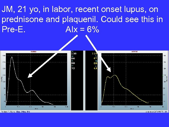 JM, 21 yo, in labor, recent onset lupus, on prednisone and plaquenil. Could see