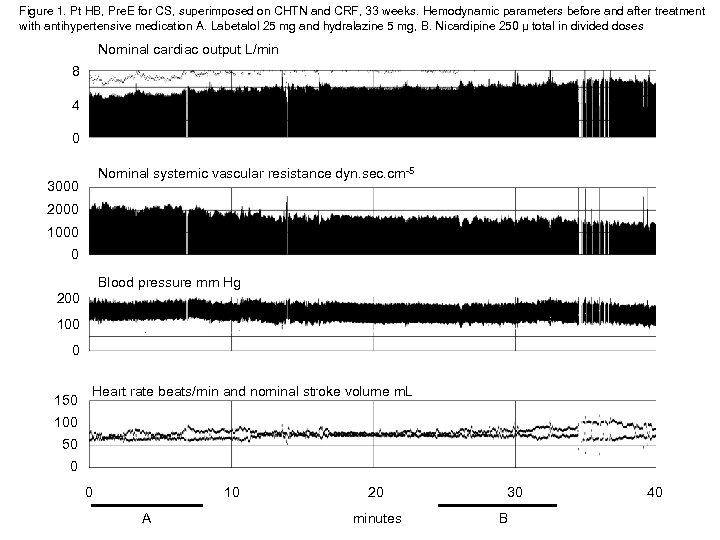 Figure 1. Pt HB, Pre. E for CS, superimposed on CHTN and CRF, 33