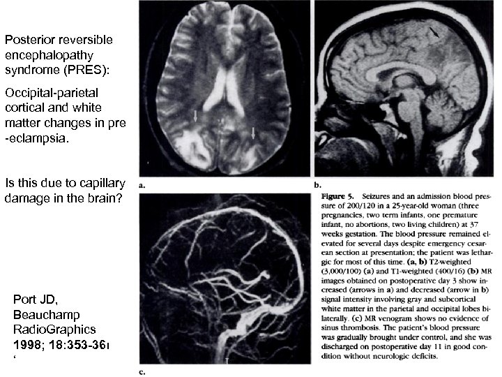 Posterior reversible encephalopathy syndrome (PRES): Occipital-parietal cortical and white matter changes in pre -eclampsia.