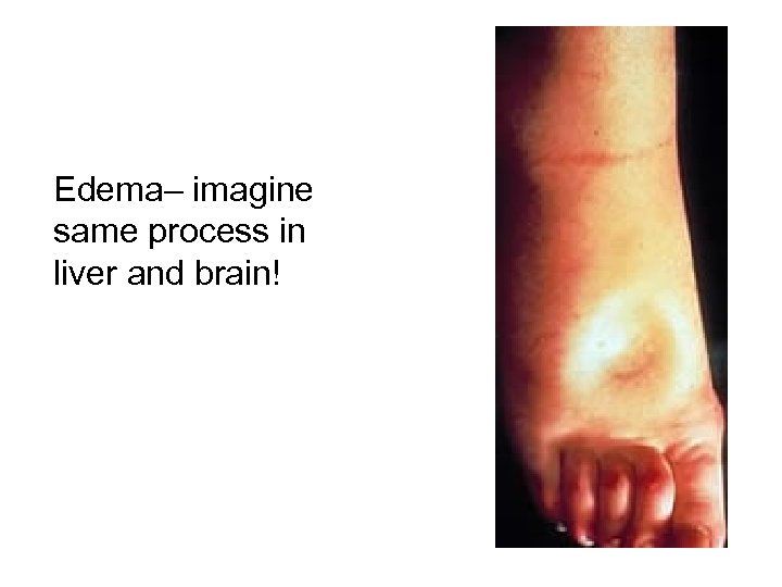 Edema– imagine same process in liver and brain! 