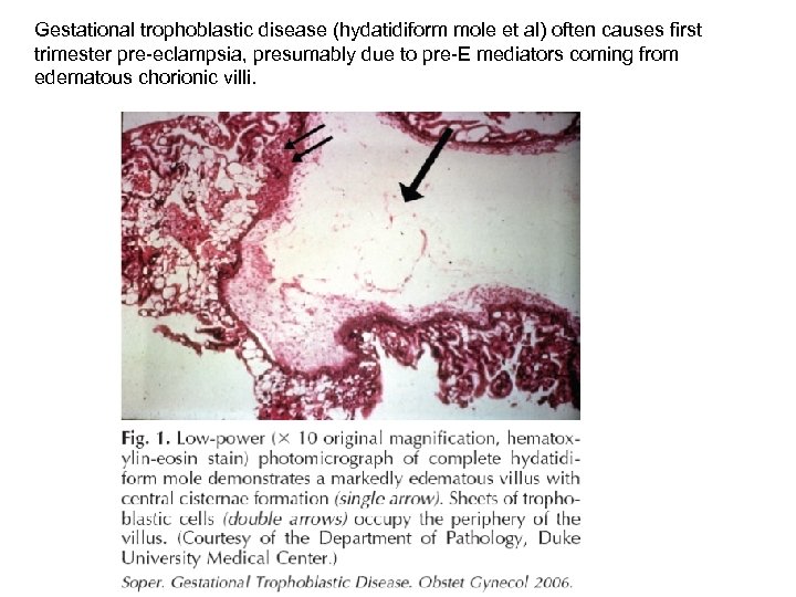 Gestational trophoblastic disease (hydatidiform mole et al) often causes first trimester pre-eclampsia, presumably due