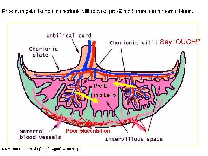 Pre-eclampsia: ischemic chorionic villi release pre-E mediators into maternal blood. Say “OUCH!” Pre-E mediators