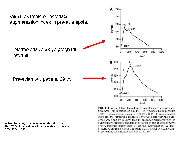 Visual example of increased augmentation index in pre-eclampsia. Normotensive 29 yo pregnant woman Pre-eclamptic