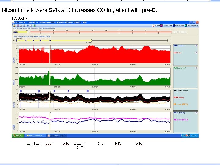 Nicardipine lowers SVR and increases CO in patient with pre-E. 