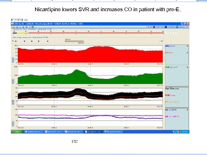 Nicardipine lowers SVR and increases CO in patient with pre-E. 