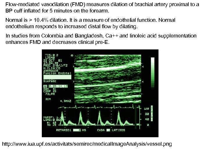 Flow-mediated vasodilation (FMD) measures dilation of brachial artery proximal to a BP cuff inflated