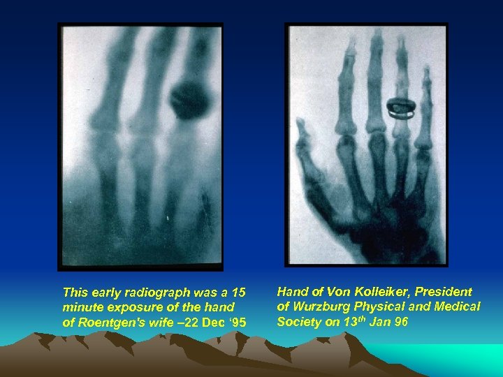 This early radiograph was a 15 minute exposure of the hand of Roentgen's wife