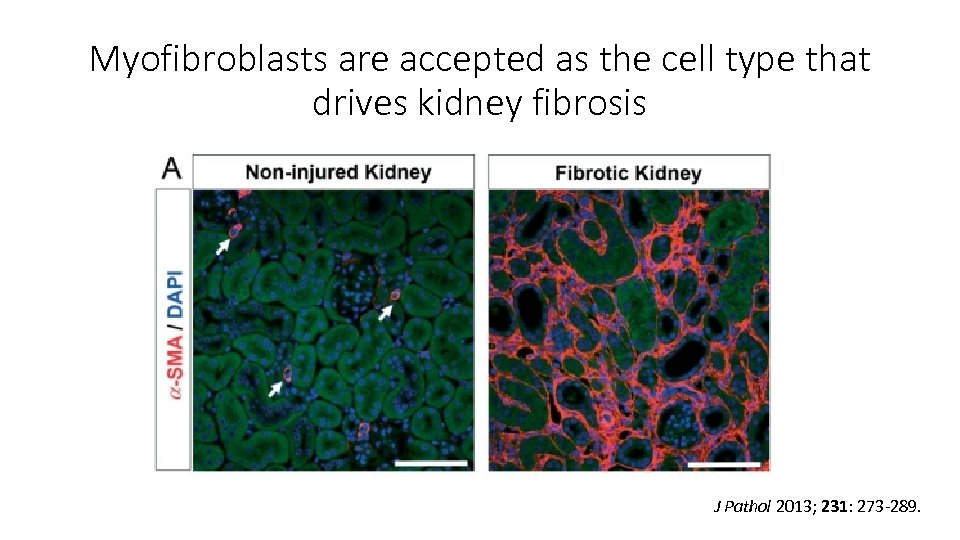Myofibroblasts are accepted as the cell type that drives kidney fibrosis J Pathol 2013;