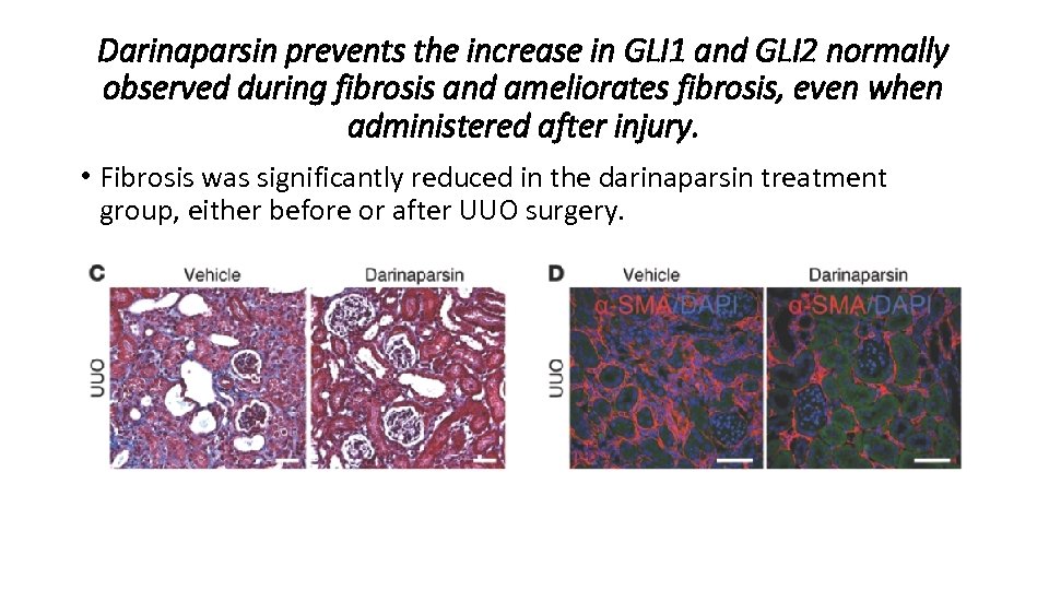 Darinaparsin prevents the increase in GLI 1 and GLI 2 normally observed during fibrosis