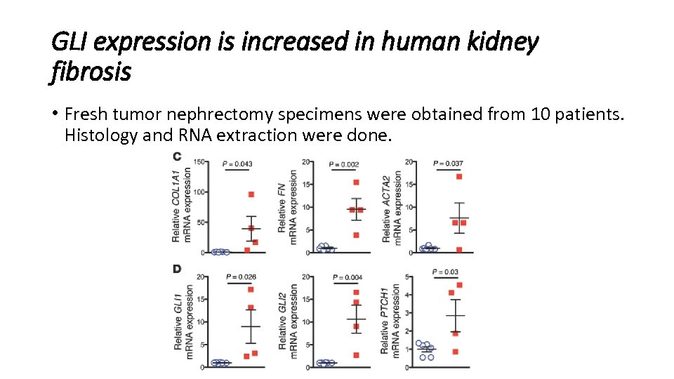 GLI expression is increased in human kidney fibrosis • Fresh tumor nephrectomy specimens were