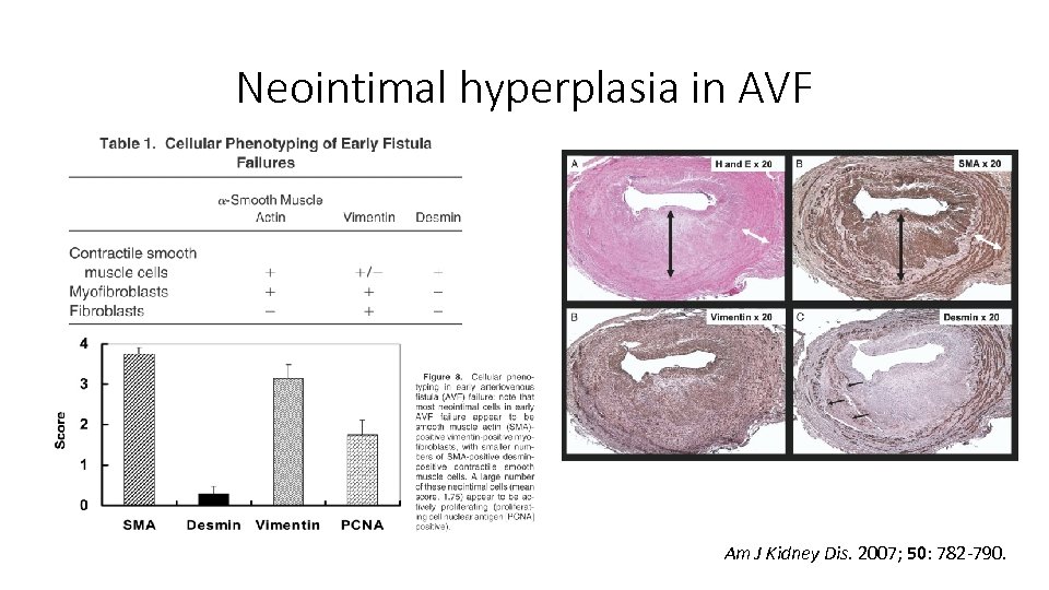 Neointimal hyperplasia in AVF Am J Kidney Dis. 2007; 50: 782 -790. 