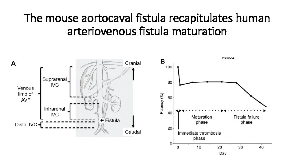 The mouse aortocaval fistula recapitulates human arteriovenous fistula maturation 