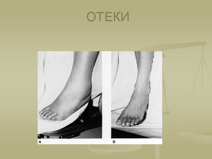 ОТЕКИ 