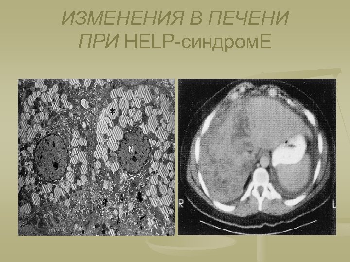 ИЗМЕНЕНИЯ В ПЕЧЕНИ ПРИ HELP-синдром. Е 