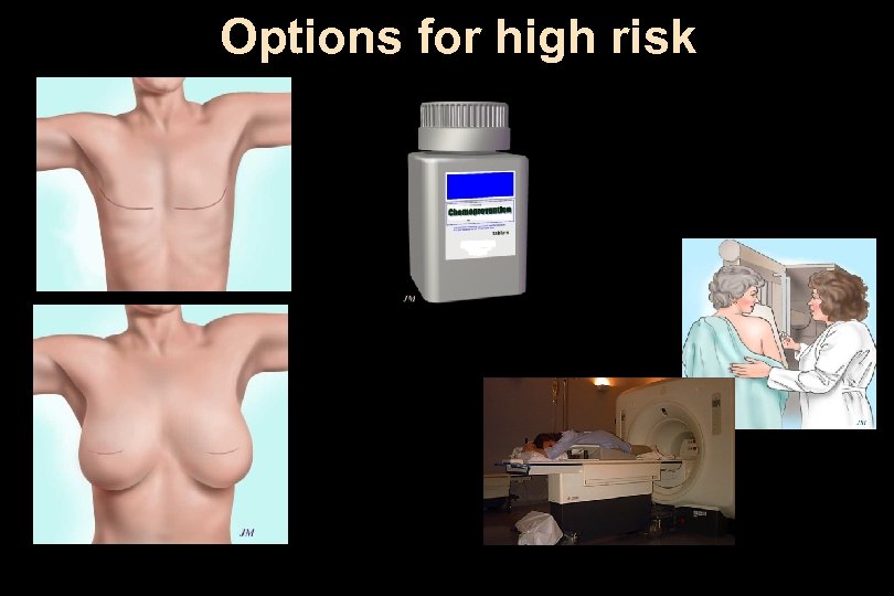 Options for high risk 