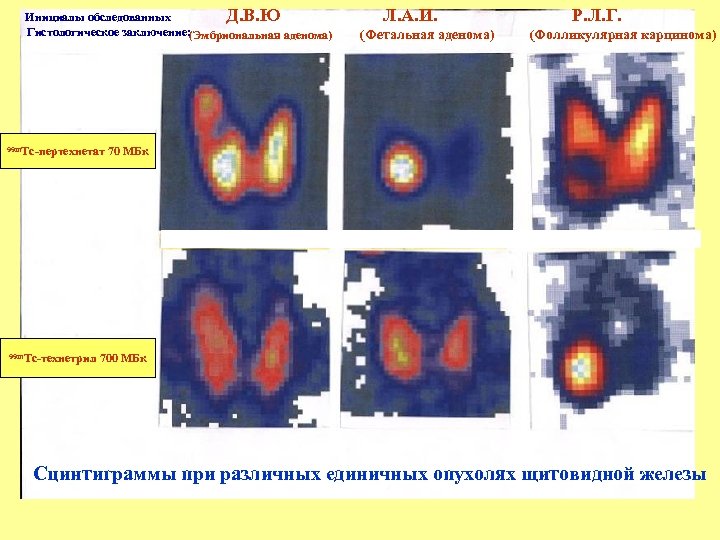 Сцинтиграфия щитовидной железы это