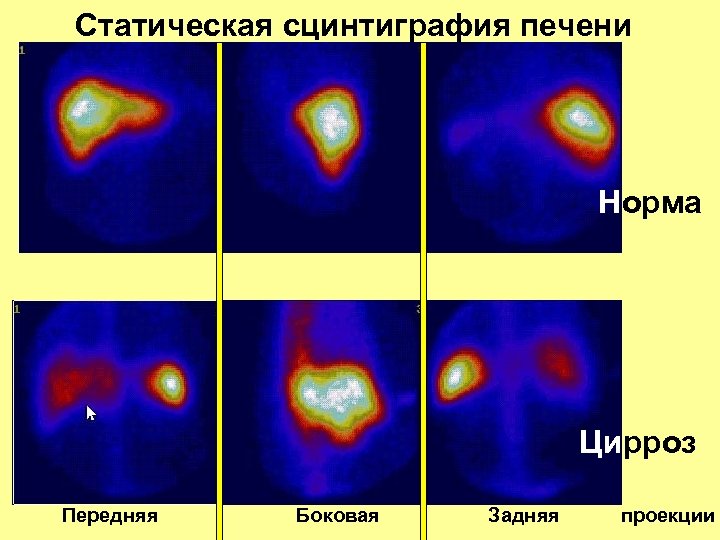 Статическая сцинтиграфия печени Норма Цирроз Передняя Боковая Задняя проекции 