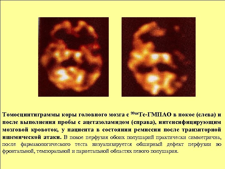 Томосцинтиграммы коры головного мозга с 99 m. Тс-ГМПАО в покое (слева) и после выполнения
