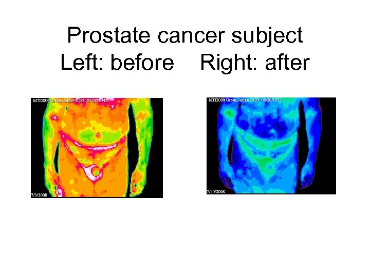 Prostate cancer subject Left: before Right: after 