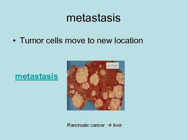 metastasis • Tumor cells move to new location metastasis Pancreatic cancer liver 
