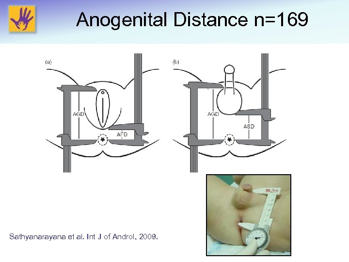 Anogenital Distance n=169 Sathyanarayana et al. Int J of Androl, 2009. 
