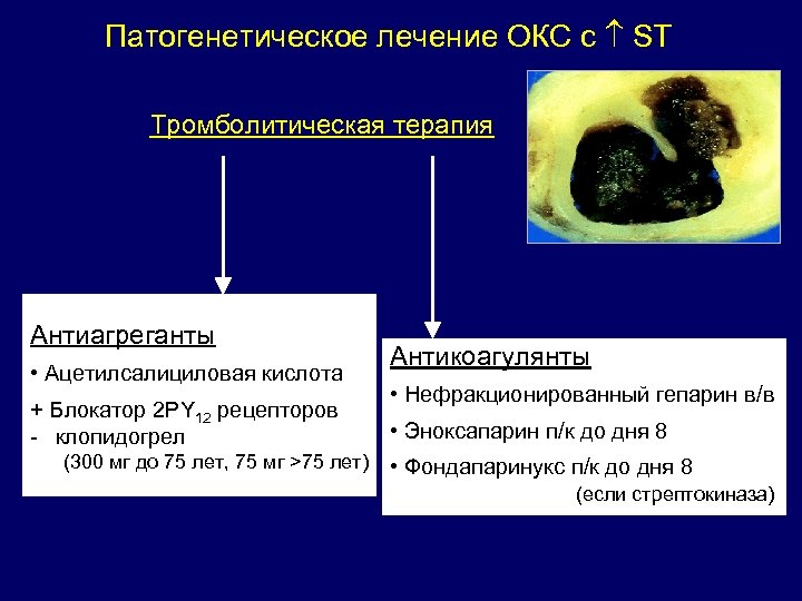 Патогенетическое лечение ОКС с ST Тромболитическая терапия Антиагреганты • Ацетилсалициловая кислота + Блокатор 2