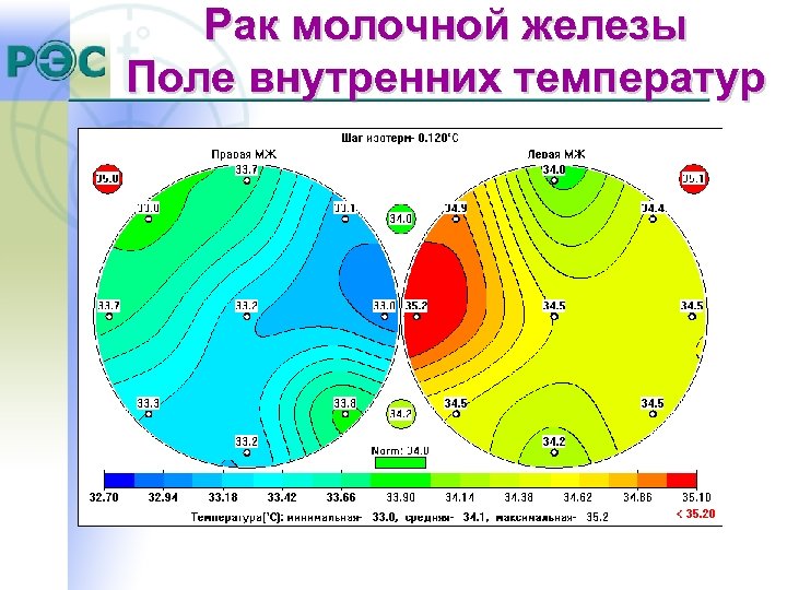 Рак молочной железы Поле внутренних температур 