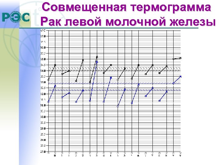 Совмещенная термограмма Рак левой молочной железы 