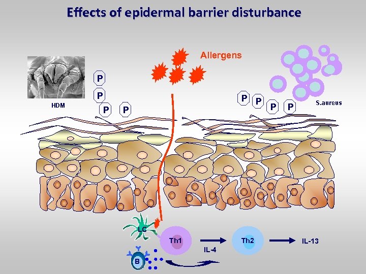 Effects of epidermal barrier disturbance Allergens P P HDM P P P S. aureus