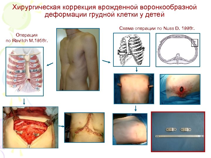 Хирургическая коррекция врожденной воронкообразной деформации грудной клетки у детей Схема операции по Nuss D.