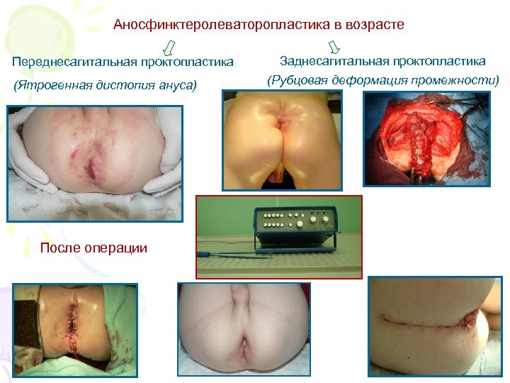 Аносфинктеролеваторопластика в возрасте Переднесагитальная проктопластика (Ятрогенная дистопия ануса) После операции Заднесагитальная проктопластика (Рубцовая деформация