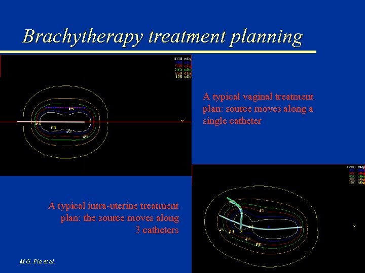 Brachytherapy treatment planning A typical vaginal treatment plan: source moves along a single catheter