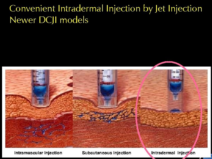 Convenient Intradermal Injection by Jet Injection Newer DCJI models 
