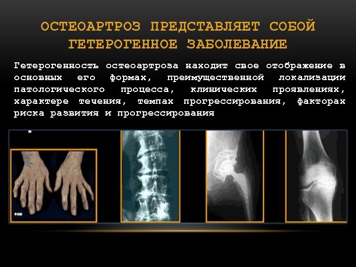 ОСТЕОАРТРОЗ ПРЕДСТАВЛЯЕТ СОБОЙ ГЕТЕРОГЕННОЕ ЗАБОЛЕВАНИЕ Гетерогенность остеоартроза находит свое отображение в основных его формах,