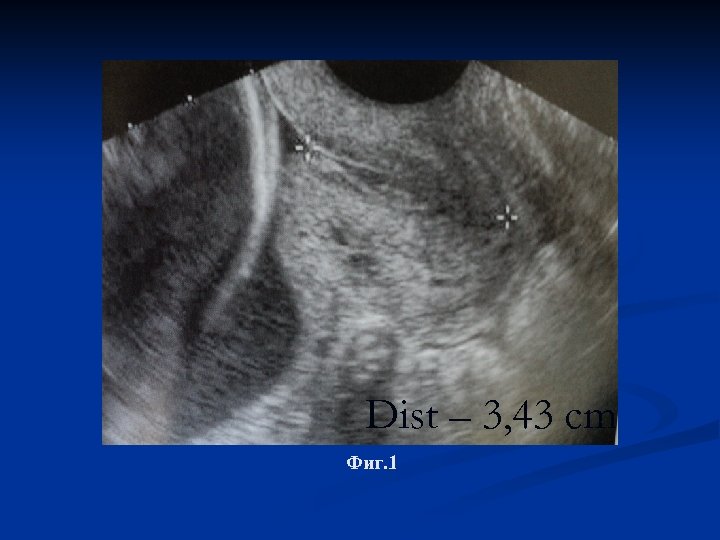 Dist – 3, 43 cm Фиг. 1 
