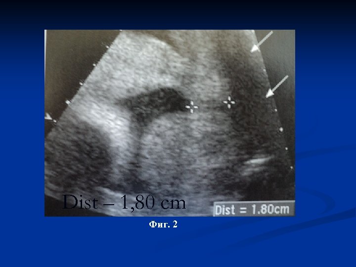 Dist – 1, 80 cm Фиг. 2 