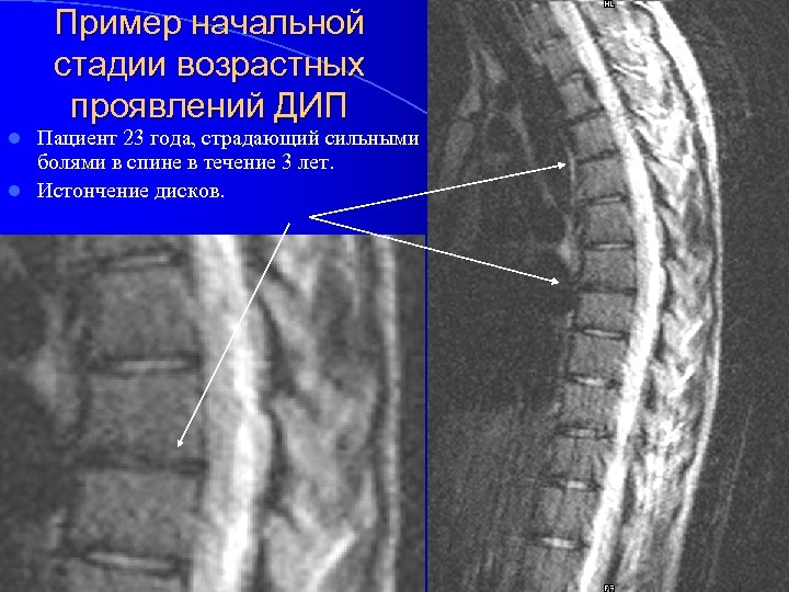 Пример начальной стадии возрастных проявлений ДИП Пациент 23 года, страдающий сильными болями в спине